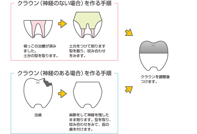 クラウンを作る手順